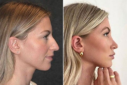 Liquid Rhinoplasty Before and After