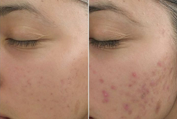 Skincare Treatment Before and After