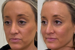 Allergan Botox 8 Allergan Botox After and Before