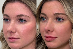 Allergan Botox Before and After