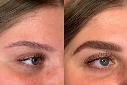 Before and After Eyebrow Hair Transplant