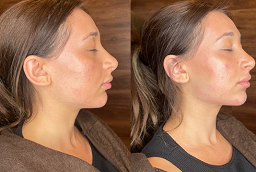 Before and After Fat Injections