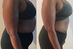 Before and After Lipotropic Injections