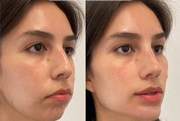 Before and After Liquid Facelift