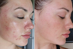 Before and After Micro-needling With PRP Therapy