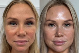 Before and After Skin Booster Injection
