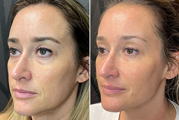 Before and After Sugar Thread Lift