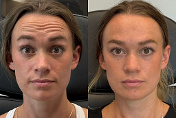 Before and After Xeomin Treatment
