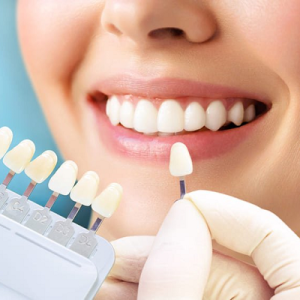E-Max Veneers Cost in Abu Dhabi