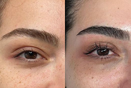 Eyebrow Hair Transplant After and Before