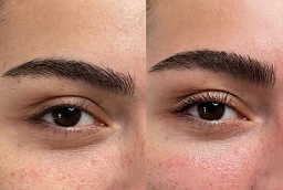 Eyebrow Hair Transplant Before and After