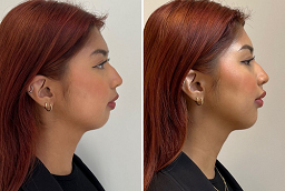 Fat Injections After and Before