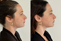 Fat Injections Before and After