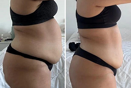 Lipotropic Injections After and Before