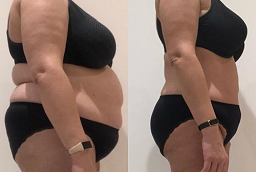 Lipotropic Injections 8 Lipotropic Injections Before and After