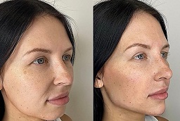 Liquid Facelift After and Before