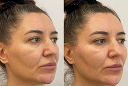 Liquid Facelift Before and After
