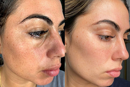 Micro-needling With PRP Therapy After and Before
