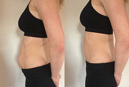 Ozempic Treatment Before and After