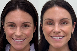 Skin Booster Injection After and Before