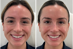 Skin Booster Injection Before and After