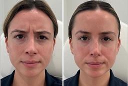 Xeomin Treatment After and Before