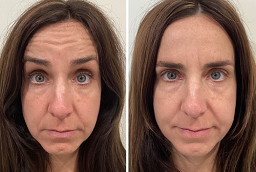 Xeomin Treatment Before and After