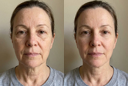 Anti Wrinkle Injections 8 Anti Wrinkle Injections After and Before
