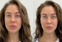 Anti Wrinkle Injections Before and After