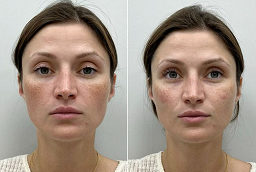 Before and After Anti Wrinkle Injections