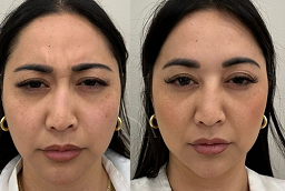 Before and After Botulinum Toxin
