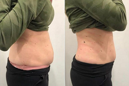 Before and After GPS Laser Liposuction