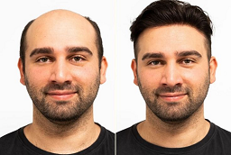 Before and After Hair Implants Clinic