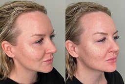 Before and After Nefertiti Lift Treatment