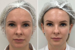 Before and After Voluma Fillers