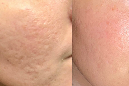 Bio Revitalization Treatment After and Before