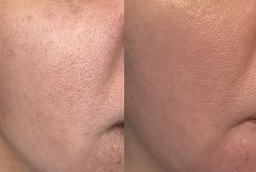 Bio Revitalization Treatment Before and After