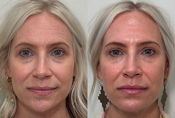 Botulinum Toxin 8 Botulinum Toxin After and Before
