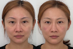 Botulinum Toxin Before and After