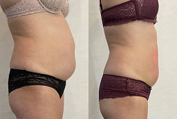 GPS Laser Liposuction After and Before