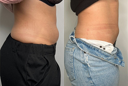 GPS Laser Liposuction Before and After