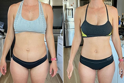 Gastric Balloon Placement Before and After