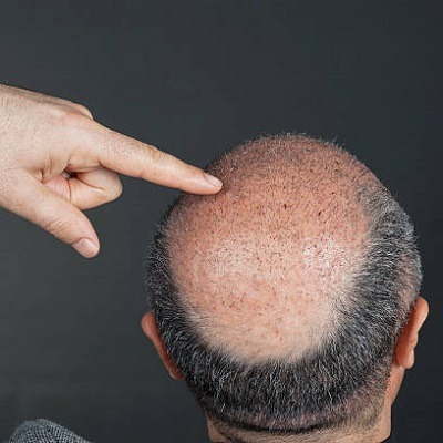 Hair Implants Cost in Abu Dhabi