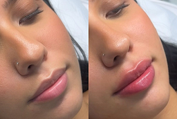 Lip Fillers After and Before