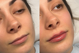 Lip Fillers Before and After