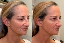 Nefertiti Lift Treatment After and Before