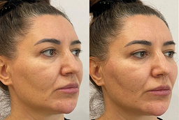 Nefertiti Lift Treatment Before and After