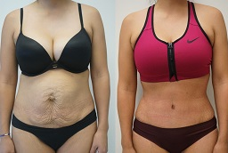 Tummy-tuck-before-and-after
