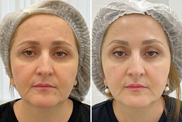 Voluma Fillers After and Before