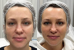 Voluma Fillers Before and After